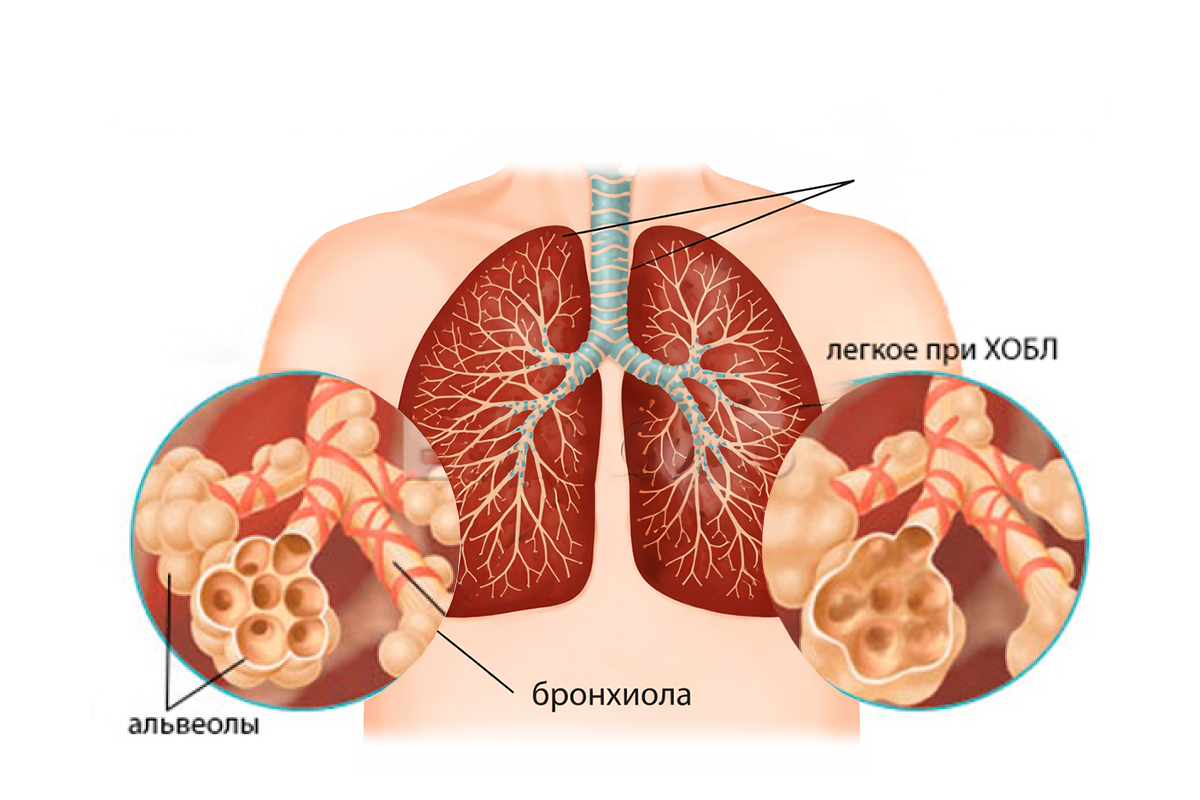 Кашлево-обморочный синдром у пациента с тяжелым обострением хронической обструктивной болезни легких