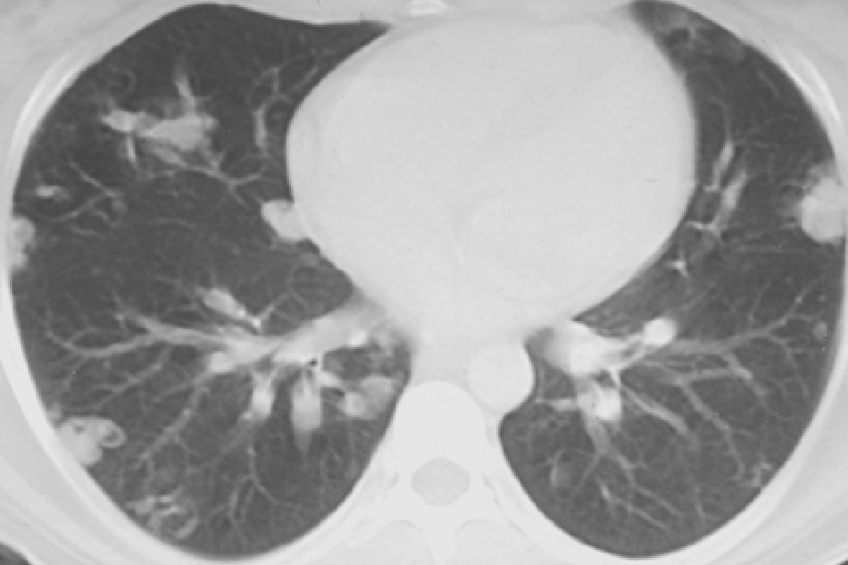Альвеококкоз легких у мужчины молодого возраста: клинический случай
