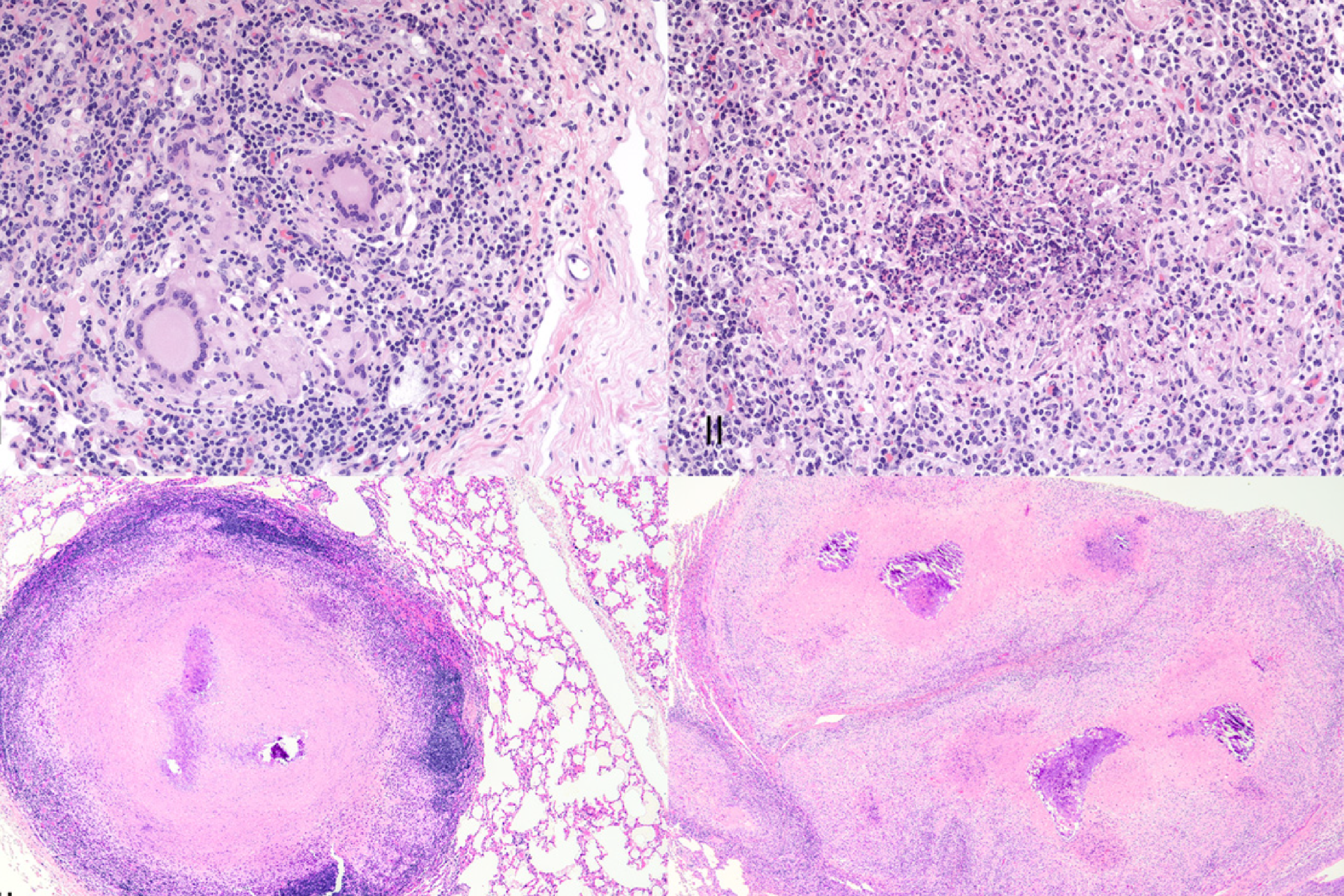ГЭРБ-ассоциированная гранулема гортани 