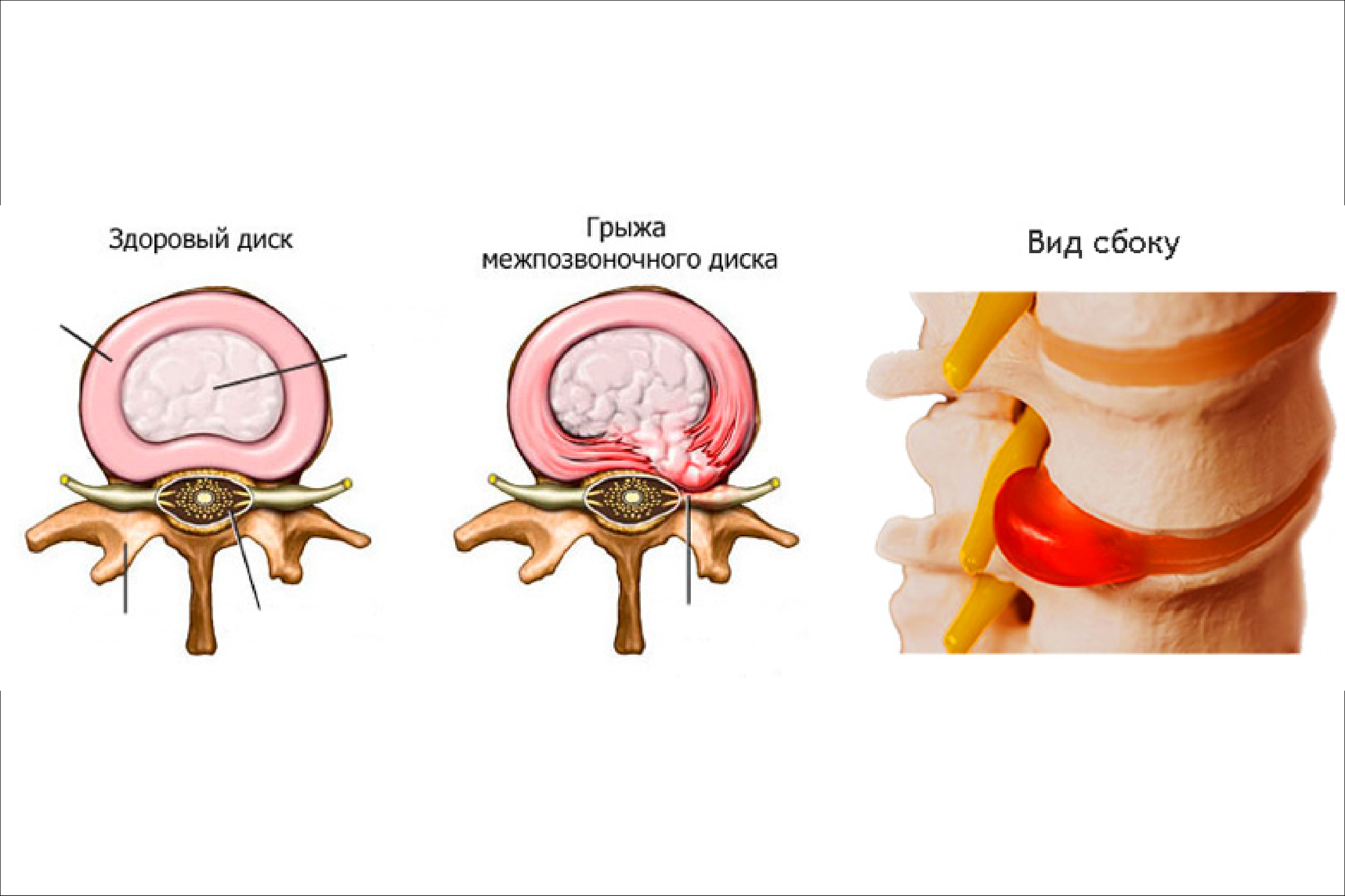 Грыжа межпозвонковых дисков: синдром «неудачной операции» 